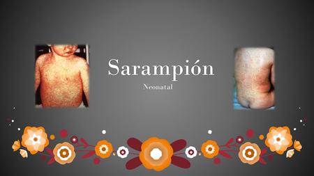 Sarampión Neonatal.