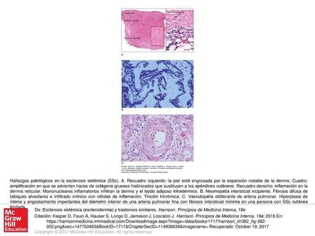 Hallazgos patológicos en la esclerosis sistémica (SSc). A