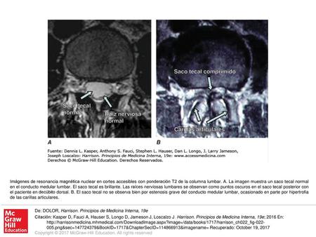 Imágenes de resonancia magnética nuclear en cortes accesibles con ponderación T2 de la columna lumbar. A. La imagen muestra un saco tecal normal en el.