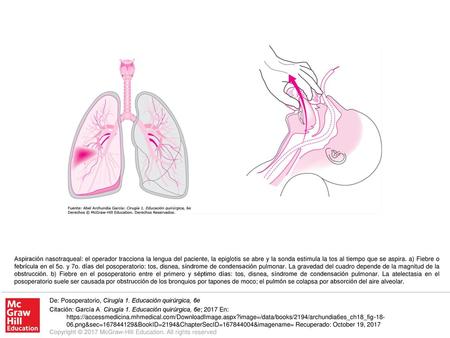 Aspiración nasotraqueal: el operador tracciona la lengua del paciente, la epiglotis se abre y la sonda estimula la tos al tiempo que se aspira. a) Fiebre.