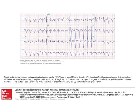 Taquicardia sinusal; retraso en la conducción intraventricular (IVCD) con un eje QRS a la derecha. El intervalo QT está prolongado para el ritmo cardiaco.