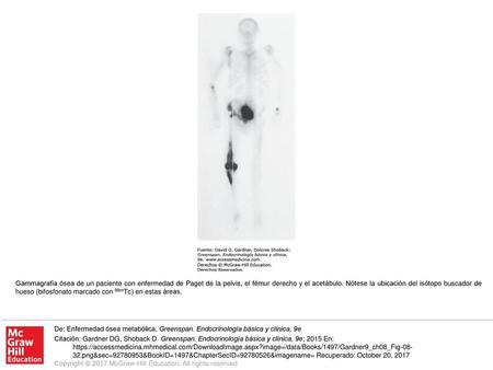 Gammagrafía ósea de un paciente con enfermedad de Paget de la pelvis, el fémur derecho y el acetábulo. Nótese la ubicación del isótopo buscador de hueso.