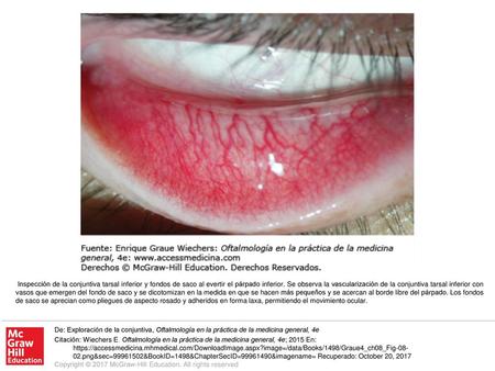 Inspección de la conjuntiva tarsal inferior y fondos de saco al evertir el párpado inferior. Se observa la vascularización de la conjuntiva tarsal inferior.