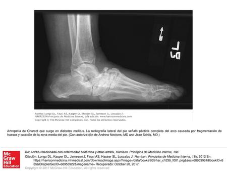 Artropatía de Charcot que surge en diabetes mellitus