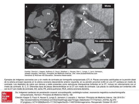 Ejemplos de imágenes coronarias con y sin medio de contraste por tomografía computarizada (CT) A. Placas coronarias calcificadas en la porción distal de.