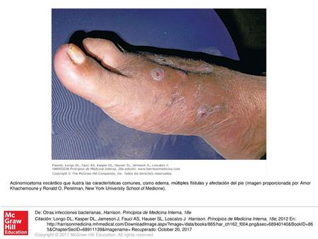 Actinomicetoma nocárdico que ilustra las características comunes, como edema, múltiples fístulas y afectación del pie (imagen proporcionada por Amor Khachemoune.