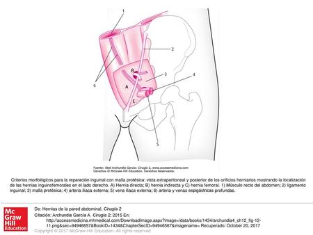 Criterios morfológicos para la reparación inguinal con malla protésica: vista extraperitoneal y posterior de los orificios herniarios mostrando la localización.