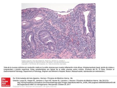 Vista de la mucosa colónica con resolución media en la colitis ulcerosa que muestra inflamación mixta difusa, linfoplasmacitosis basal, atrofia de criptas.