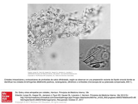 Cristales intracelulares y extracelulares de pirofosfato de calcio dihidratado, según se observan en una preparación reciente de líquido sinovial donde.