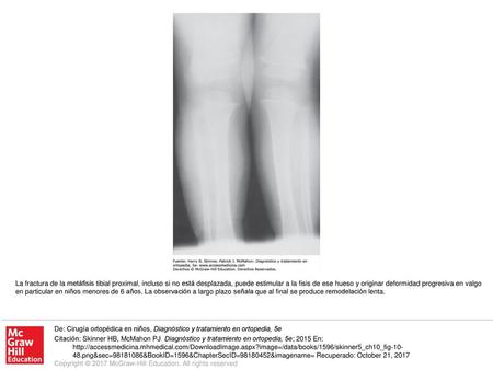 La fractura de la metáfisis tibial proximal, incluso si no está desplazada, puede estimular a la fisis de ese hueso y originar deformidad progresiva en.