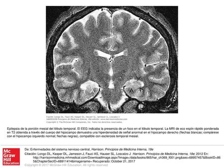 Epilepsia de la porción mesial del lóbulo temporal