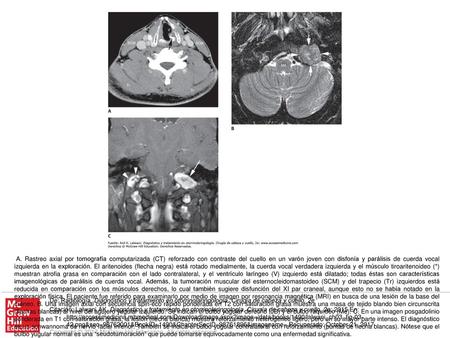 A. Rastreo axial por tomografía computarizada (CT) reforzado con contraste del cuello en un varón joven con disfonía y parálisis de cuerda vocal izquierda.
