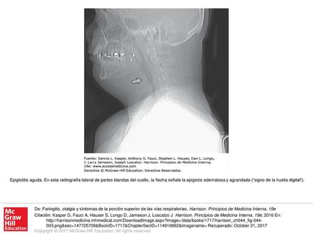 Epiglotitis aguda. En esta radiografía lateral de partes blandas del cuello, la flecha señala la epiglotis edematosa y agrandada (“signo de la huella digital”).