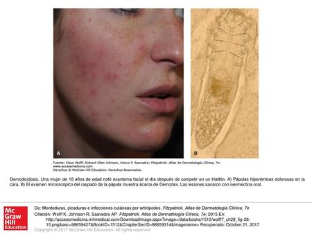 Demodicidosis. Una mujer de 18 años de edad notó exantema facial el día después de competir en un triatlón. A) Pápulas hiperémicas dolorosas en la cara.
