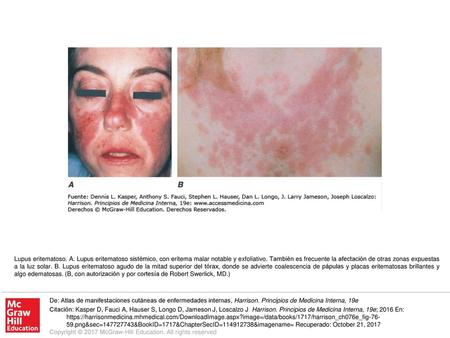 Lupus eritematoso. A. Lupus eritematoso sistémico, con eritema malar notable y exfoliativo. También es frecuente la afectación de otras zonas expuestas.