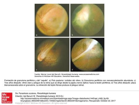 Formación de granuloma periférico y del “capullo”