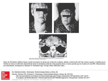 Signo de Pemberton (plétora facial) cuando los brazos se elevan por arriba de la cabeza, debido a obstrucción del flujo venoso yugular a medida que la.