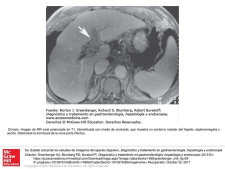 Cirrosis. Imagen de MR axial potenciada en T1, intensificada con medio de contraste, que muestra un contorno nodular del hígado, esplenomegalia y ascitis.