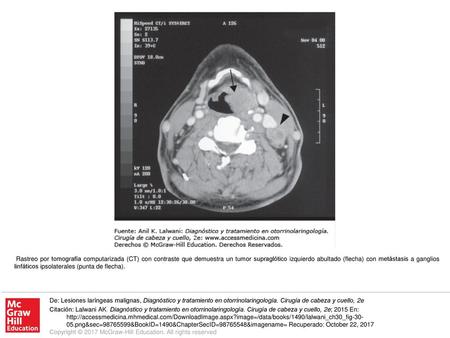 Rastreo por tomografía computarizada (CT) con contraste que demuestra un tumor supraglótico izquierdo abultado (flecha) con metástasis a ganglios linfáticos.