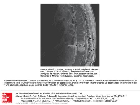 Osteomielitis vertebral por S