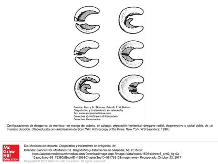 Configuraciones de desgarros de menisco: en mango de cubeta, en colgajo, separación horizontal; desgarro radial, degenerativo o radial doble, de un menisco.