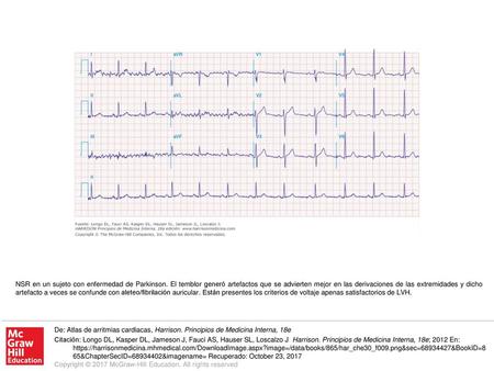 NSR en un sujeto con enfermedad de Parkinson