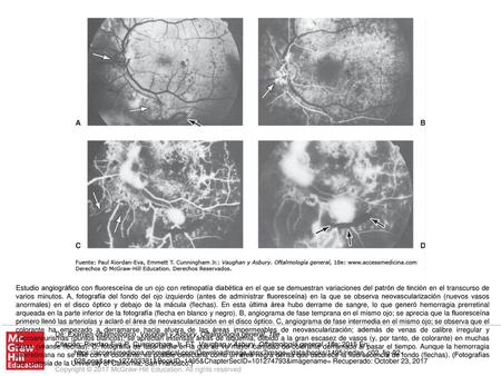 Estudio angiográfico con fluoresceína de un ojo con retinopatía diabética en el que se demuestran variaciones del patrón de tinción en el transcurso de.