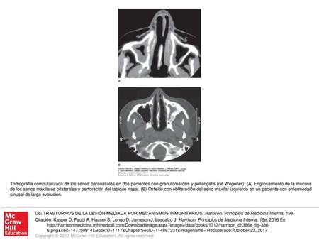 Tomografía computarizada de los senos paranasales en dos pacientes con granulomatosis y poliangiítis (de Wegener). (A) Engrosamiento de la mucosa de los.