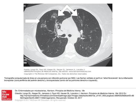 Tomografía computarizada de tórax en una persona con infección pulmonar por MAC. Las flechan señalan el perfil en “árbol floreciendo” de la inflamación.