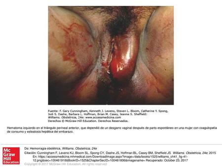 Hematoma izquierdo en el triángulo perineal anterior, que dependió de un desgarro vaginal después de parto espontáneo en una mujer con coagulopatía de.
