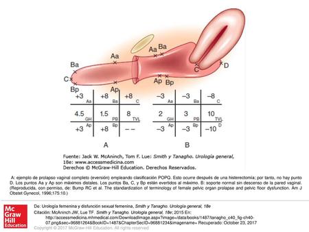 A: ejemplo de prolapso vaginal completo (eversión) empleando clasificación POPQ. Esto ocurre después de una histerectomía; por tanto, no hay punto D. Los.