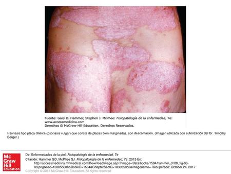 Psoriasis tipo placa clásica (psoriasis vulgar) que consta de placas bien marginadas, con descamación. (Imagen utilizada con autorización del Dr. Timothy.