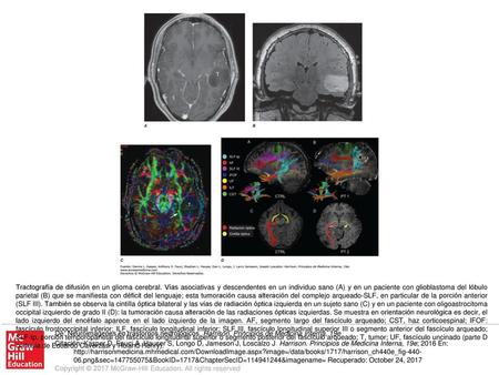 Tractografía de difusión en un glioma cerebral