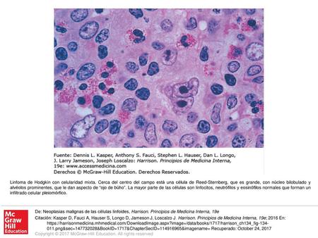 Linfoma de Hodgkin con celularidad mixta