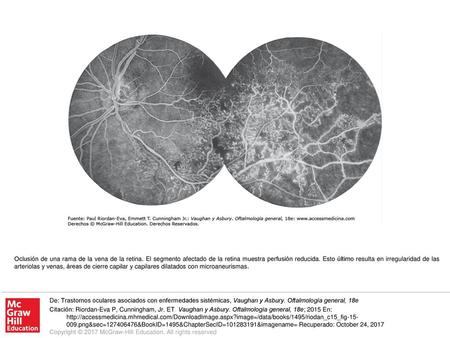 Oclusión de una rama de la vena de la retina