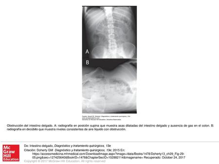 Obstrucción del intestino delgado