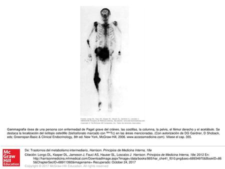 Gammagrafía ósea de una persona con enfermedad de Paget grave del cráneo, las costillas, la columna, la pelvis, el fémur derecho y el acetábulo. Se destaca.