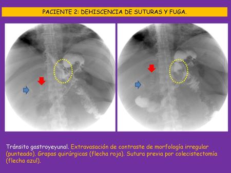PACIENTE 2: DEHISCENCIA DE SUTURAS Y FUGA.