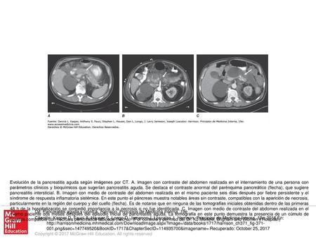 Evolución de la pancreatitis aguda según imágenes por CT. A