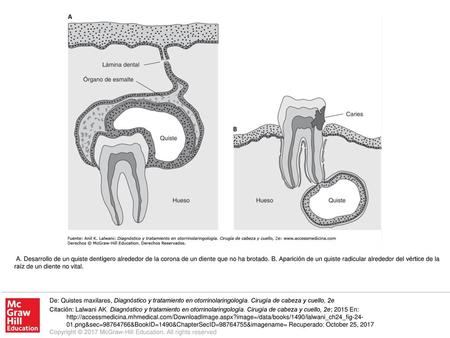 A. Desarrollo de un quiste dentígero alrededor de la corona de un diente que no ha brotado. B. Aparición de un quiste radicular alrededor del vértice de.