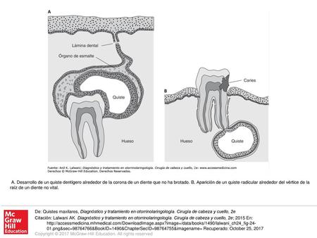 A. Desarrollo de un quiste dentígero alrededor de la corona de un diente que no ha brotado. B. Aparición de un quiste radicular alrededor del vértice de.