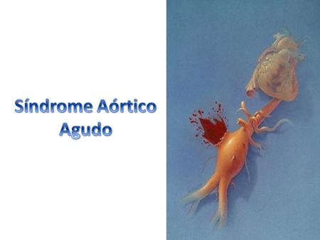 Síndrome Aórtico Agudo.