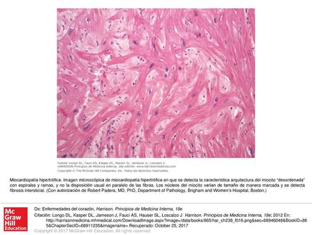 Miocardiopatía hipertrófica