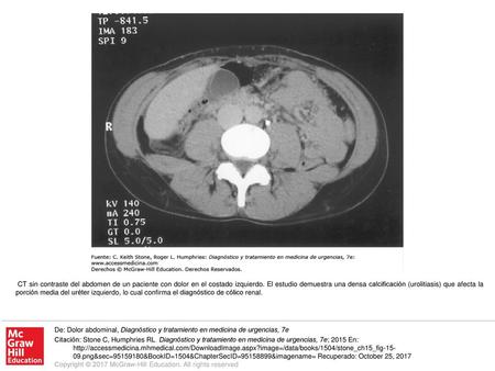 CT sin contraste del abdomen de un paciente con dolor en el costado izquierdo. El estudio demuestra una densa calcificación (urolitiasis) que afecta la.