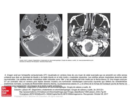 A. Imagen axial por tomografía computarizada (CT) visualizada en ventana ósea de una mujer de edad avanzada que se presentó con otitis serosa unilateral.