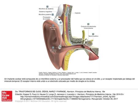Un implante coclear está compuesto de un micrófono externo y un procesador del habla que se coloca en el oído, y un receptor implantado por debajo del.