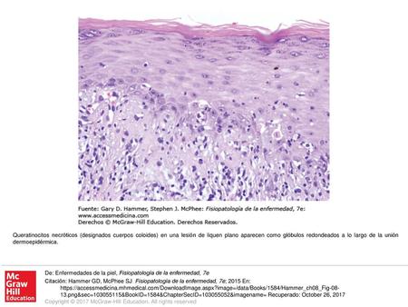 Queratinocitos necróticos (designados cuerpos coloides) en una lesión de liquen plano aparecen como glóbulos redondeados a lo largo de la unión dermoepidérmica.
