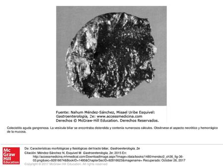 Colecistitis aguda gangrenosa