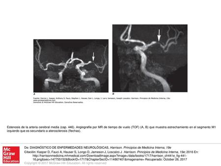Estenosis de la arteria cerebral media (cap. 446)