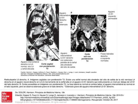 Radiculopatía L5 derecha. A. Imágenes sagitales con ponderación T2
